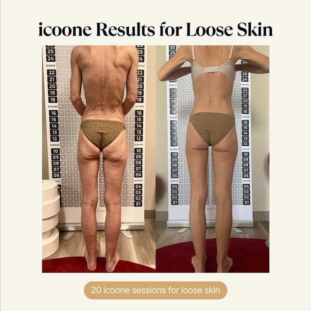 Cryoslimming/Cryotoning at Lush Cryo and Wellness in Reno, NV